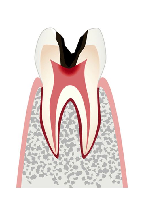 medical01 c3 - 虫歯