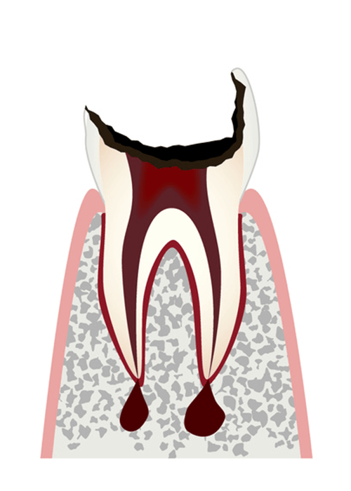 medical01 c4 - 虫歯